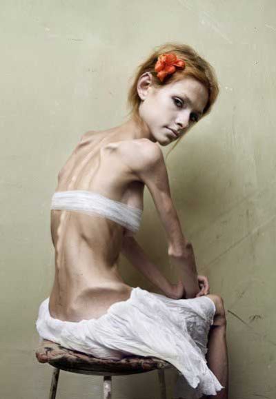http://skuky.net/wp-content/uploads/2009/06/anorexia_36.jpg